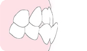 下の歯が、上の歯より外側にある。